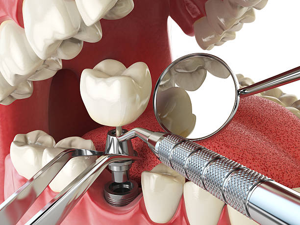 Best Emergency Tooth Extraction in New Whiteland, IN